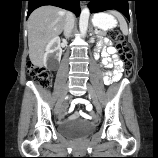 File:Atypical renal cyst (Radiopaedia 17536-17251 C 17).jpg