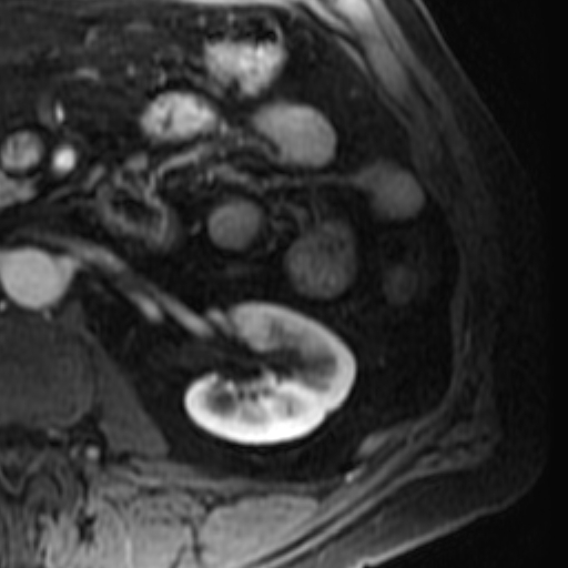 File:Atypical renal cyst on MRI (Radiopaedia 17349-17046 C 19).jpg