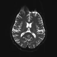 File:Autoimmune limbic encephalitis (Radiopaedia 30363-31005 Axial B0 and DWI 19).jpg