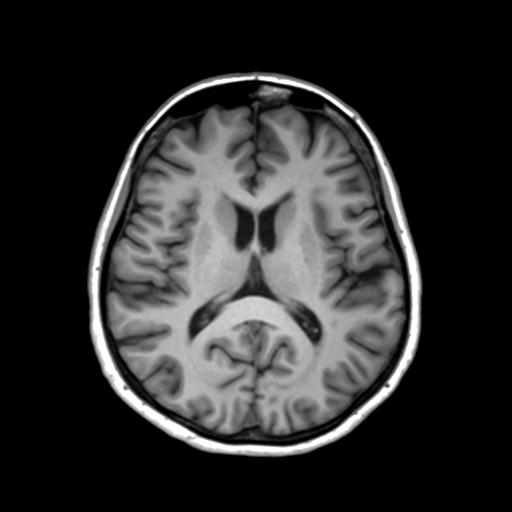 Autoimmune limbic encephalitis (Radiopaedia 30363-31005 T1 Axial 3mm 29).jpg