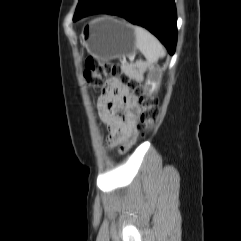 Autosomal dominant polycystic kidney disease (Radiopaedia 23061-23093 F 48).jpg
