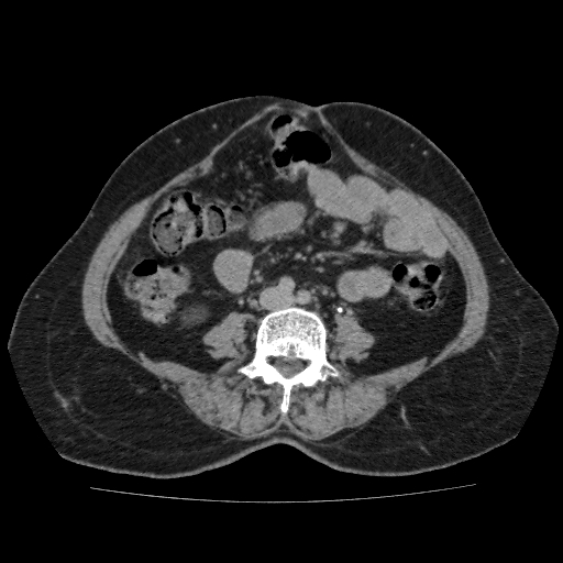 Autosomal dominant polycystic kidney disease (Radiopaedia 38189-40194 Axial C+ delayed 33).jpg