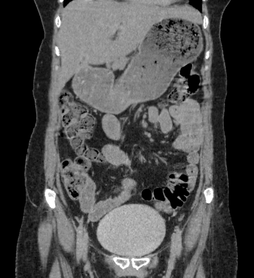 Autosomal dominant polycystic kidney disease (Radiopaedia 38189-40194 Coronal C+ delayed 18).jpg