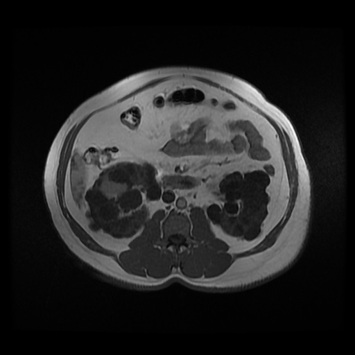 Autosomal dominant polycystic kidney disease (Radiopaedia 50259-55611 Axial 2D Dual Echo 50).jpg