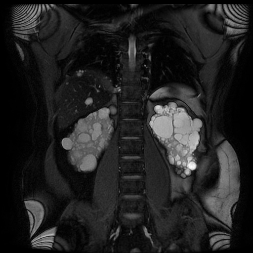 File:Autosomal dominant polycystic kidney disease (Radiopaedia 50259-55611 Coronal FIESTA 24).jpg