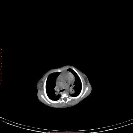 Autosomal recessive polycystic kidney disease associated with Caroli disease (Radiopaedia 61932-69984 Axial non-contrast 43).jpg