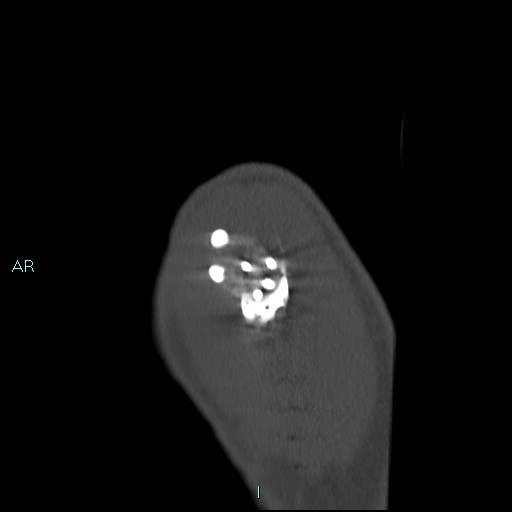File:Avascular necrosis after fracture dislocations of the proximal humerus (Radiopaedia 88078-104653 Sagittal bone window 12).jpg