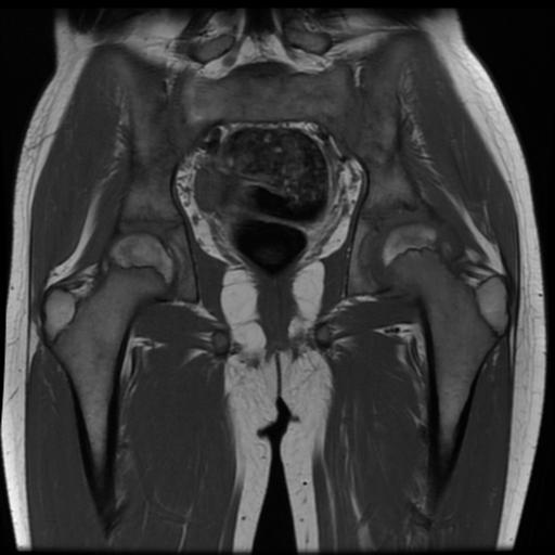 File:Avascular necrosis of the hip (Radiopaedia 29563-30067 Coronal T1 10).jpg