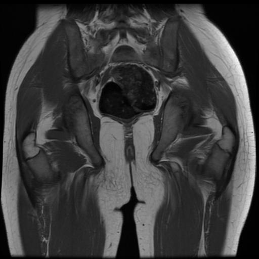 File:Avascular necrosis of the hip (Radiopaedia 29563-30067 Coronal T1 13).jpg
