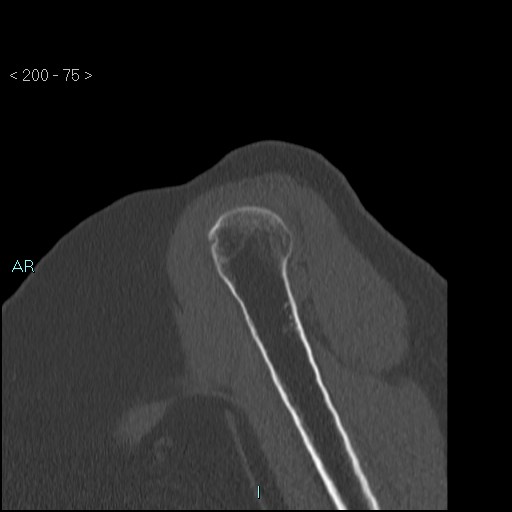 Avascular necrosis of the shoulder - Cruess stage I (Radiopaedia 77674-89887 Sagittal bone window 74).jpg