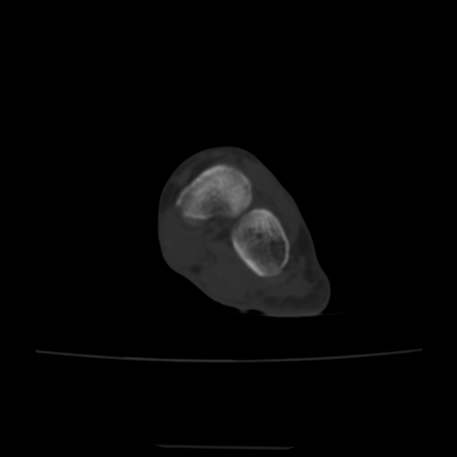 Avulsion fracture of the dorsal cuboid bone (Radiopaedia 51586-57377 Axial bone window 84).jpg