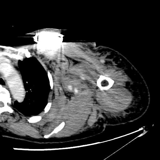 File:Axillary arterial pseudoaneurysm (Radiopaedia 24925-25195 A 15).jpg