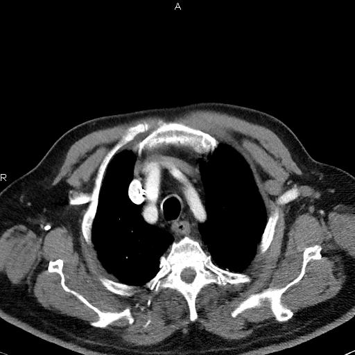 Azygos continuation of the inferior vena cava (Radiopaedia 18537-18404 C+ arterial phase 12).jpg