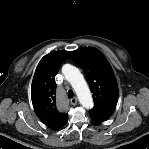 Azygos continuation of the inferior vena cava (Radiopaedia 18537-18404 C+ arterial phase 18).jpg