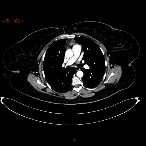 Azygos fissure and lobe (Radiopaedia 47620-52278 A 88).jpg