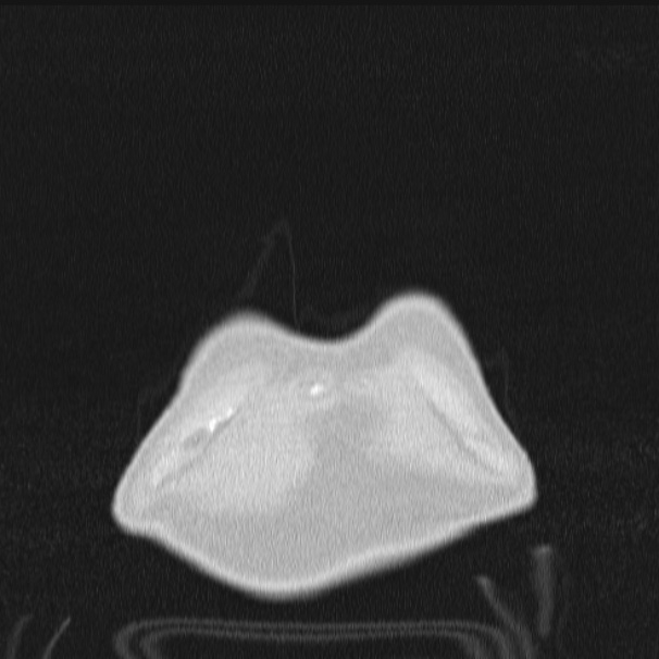 Azygos lobe (Radiopaedia 38259-40275 Coronal lung window 3).jpg