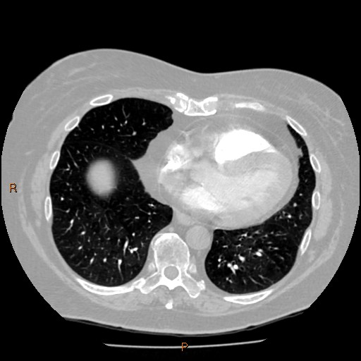Azygos lobe (Radiopaedia 40161-42821 Axial lung window 51).jpg