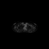 B-cell lymphoma of the mesentery (Radiopaedia 65743-74868 18F-FDG PET-CT 226).jpg