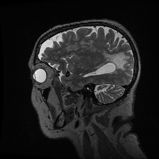 Balo concentric sclerosis (Radiopaedia 53875-59982 Sagittal 3D FSE 70).jpg