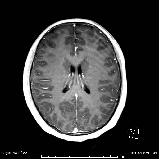Balo concentric sclerosis (Radiopaedia 61637-69636 Axial T1 C+ 48).jpg