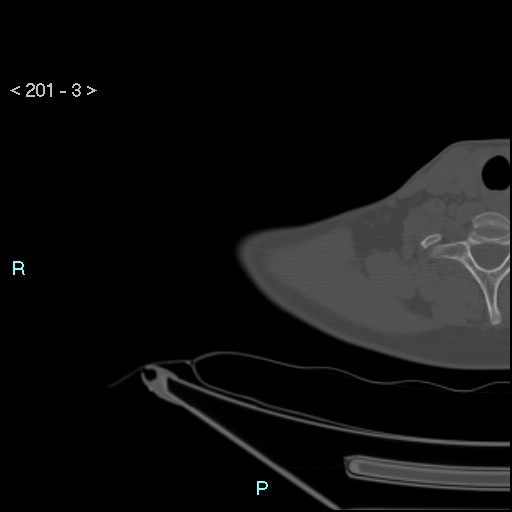 Bankart lesion with glenoid bone defect - assessment TC with PICO method (Radiopaedia 42855-93901 Axial bone window 2).jpg
