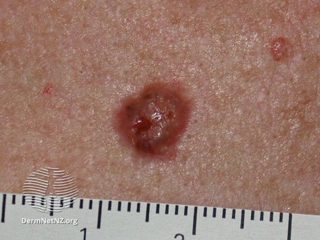 File:Basal cell carcinoma affecting the trunk (DermNet NZ lesions-bcc-trunk-0902).jpg