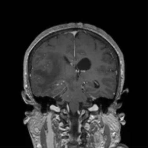 Basal ganglia metastasis (Radiopaedia 78928-91828 Coronal T1 C+ 7).png