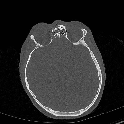 Base of skull fracture with bilateral Le Fort fractures (Radiopaedia 47094-51638 Axial bone window 47).jpg