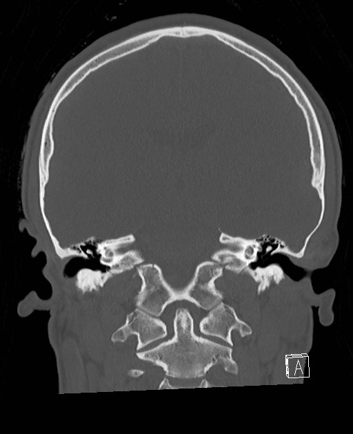 Base of skull fracture with bilateral Le Fort fractures (Radiopaedia 47094-51638 Coronal bone window 43).jpg
