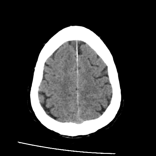 File:Basilar artery occlusion (Radiopaedia 33570-34659 Axial non-contrast 30).png