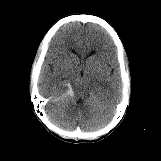 File:Basilar artery perforator aneurysm (Radiopaedia 82455-96597 Axial non-contrast 16).jpg