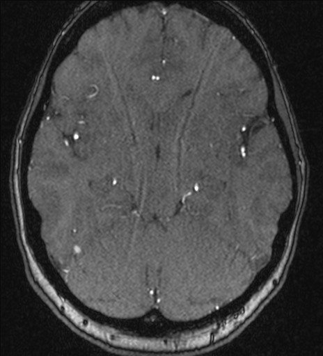 Basilar tip aneurysm (Radiopaedia 26504-26632 MRA 99).jpg