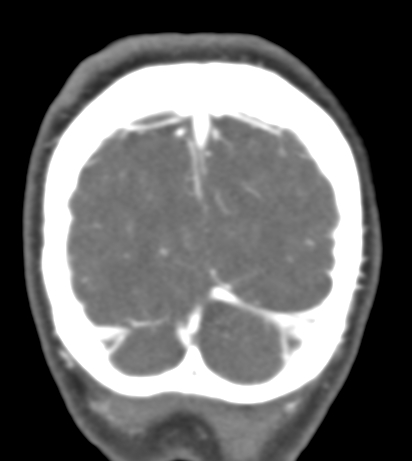 File:Basilar tip aneurysm with coiling (Radiopaedia 53912-60086 B 145).jpg