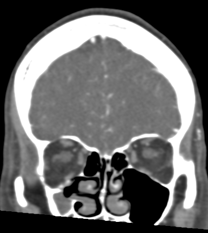 Basilar tip aneurysm with coiling (Radiopaedia 53912-60086 B 27).jpg