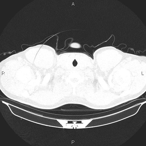 File:Beam hardening and ring artifacts (Radiopaedia 85323-100915 Axial lung window 1).jpg