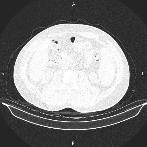 Beam hardening and ring artifacts (Radiopaedia 85323-100915 Axial lung window 90).jpg