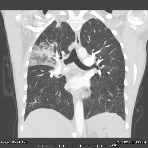 Behçet disease (Radiopaedia 44247-47889 Coronal lung window 28).jpg