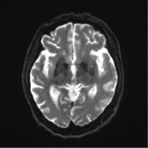 Behavioral variant frontotemporal dementia and late onset schizophrenia (Radiopaedia 52197-58083 Axial DTI Trace W 12).png