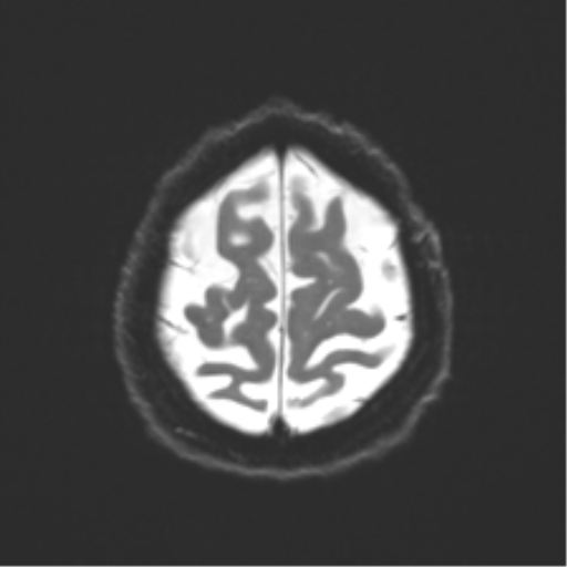 File:Behavioral variant frontotemporal dementia and late onset schizophrenia (Radiopaedia 52197-58083 Axial DTI Trace W 23).png