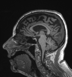 Behavioral variant frontotemporal dementia and late onset schizophrenia (Radiopaedia 52197-58083 Sagittal T1 45).png