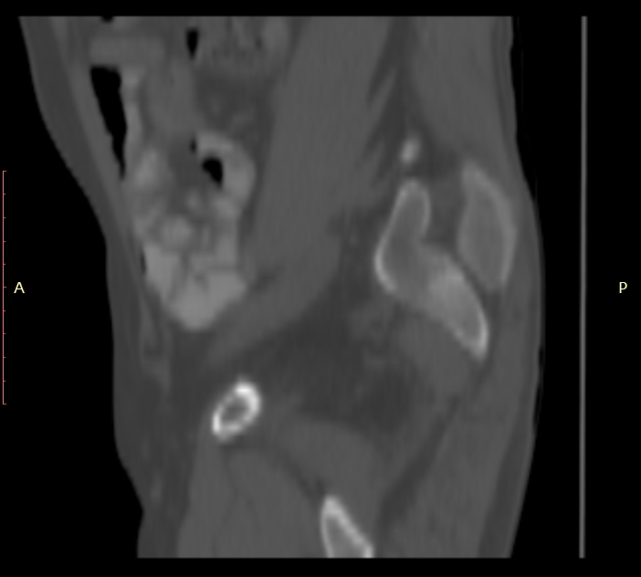 Bertolotti syndrome (Radiopaedia 58974-66235 Sagittal bone window 1).jpg