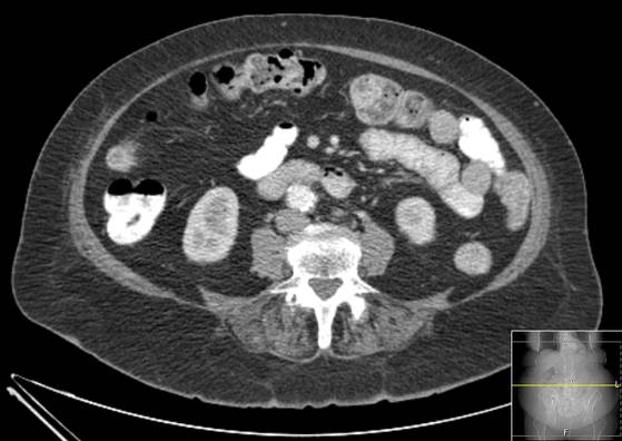 File:Bicameral celiacomesenteric aneurysm (Radiopaedia 55766-62327 A 36).jpg