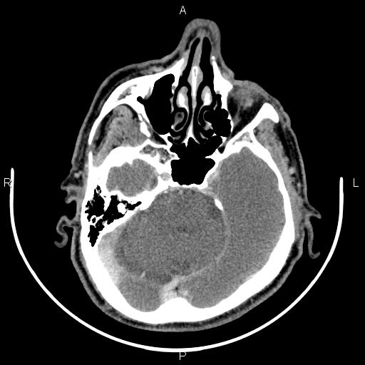 Bilateral Warthin tumors (Radiopaedia 84034-99263 Axial With contrast 3).jpg