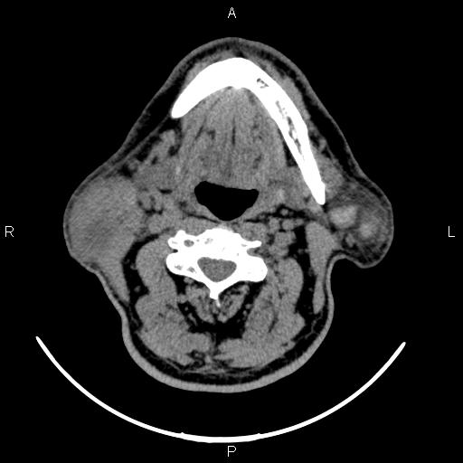 Bilateral Warthin tumors (Radiopaedia 84034-99263 Axial non-contrast 30).jpg