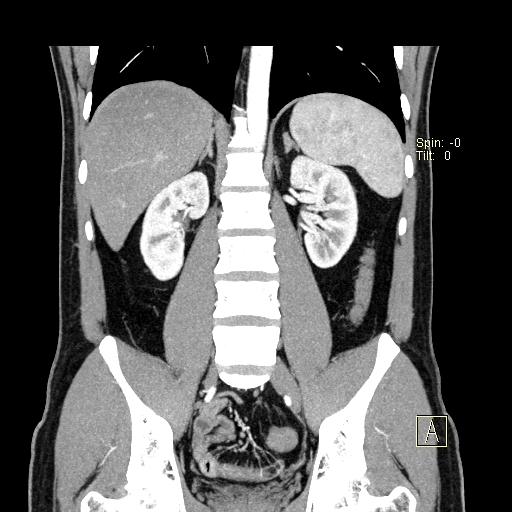File:Bilateral accessory renal arteries with mild pelvi-ureteric junction (PUJ) obstruction (Radiopaedia 66357-75596 B 30).jpg