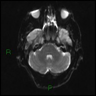 File:Bilateral acute middle cerebral artery territory infarcts (Radiopaedia 77319-89402 Axial DWI 7).jpg