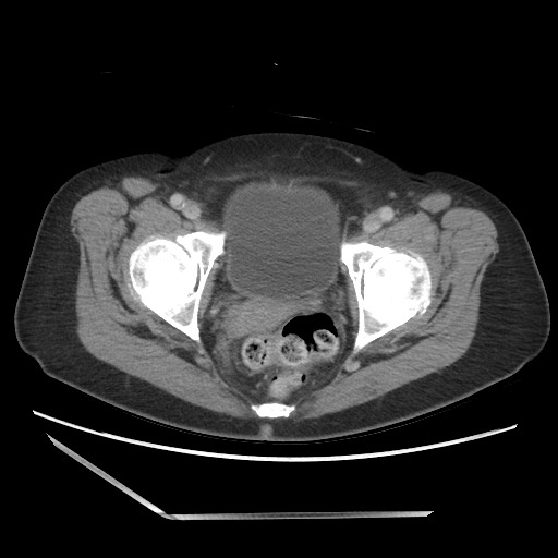 Bilateral adrenal granulocytic sarcomas (chloromas) (Radiopaedia 78375-91007 A 111).jpg