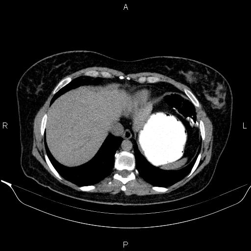 Bilateral adrenal myelolipoma (Radiopaedia 63058-71535 Axial non-contrast 15).jpg