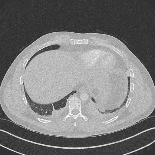 Bilateral atelectasis (Radiopaedia 48666-53675 Axial lung window 90).jpg