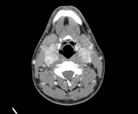 Bilateral carotid body tumors (Radiopaedia 61841-69870 Axial Post contrast 54).jpg